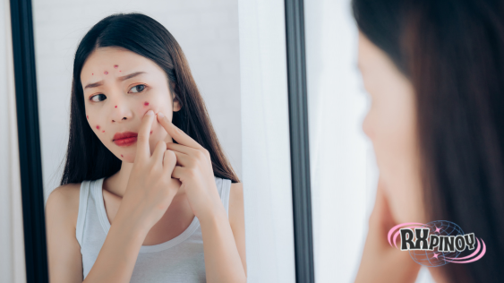 การรักษาสิวด้วยวิธีธรรมชาติเคล็ดลับจากสมุนไพรและส่วนผสมธรรมชาติ