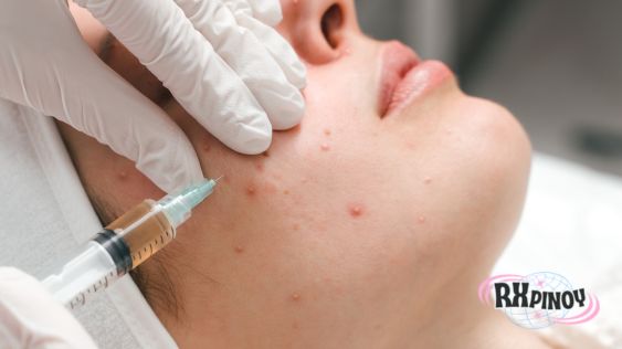 การปรึกษากับผู้เชี่ยวชาญก่อนเข้ารับคอร์สรักษาสิวสิ่งที่คุณควรรู้