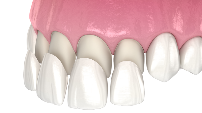 วีเนียร์ คืออะไร และช่วยเสริมสุขภาพฟันได้อย่างไร